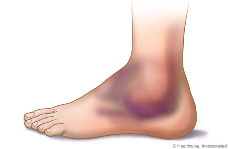 Ankle_Swelling-3