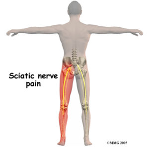 pain_sciatic_nerve01