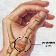 Picture of the anatomy of thumb arthritis