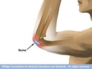 Picture of the bursa in elbow bursitis